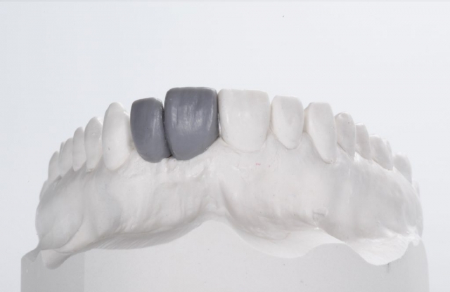 Wax Up - Individuelle Abutments